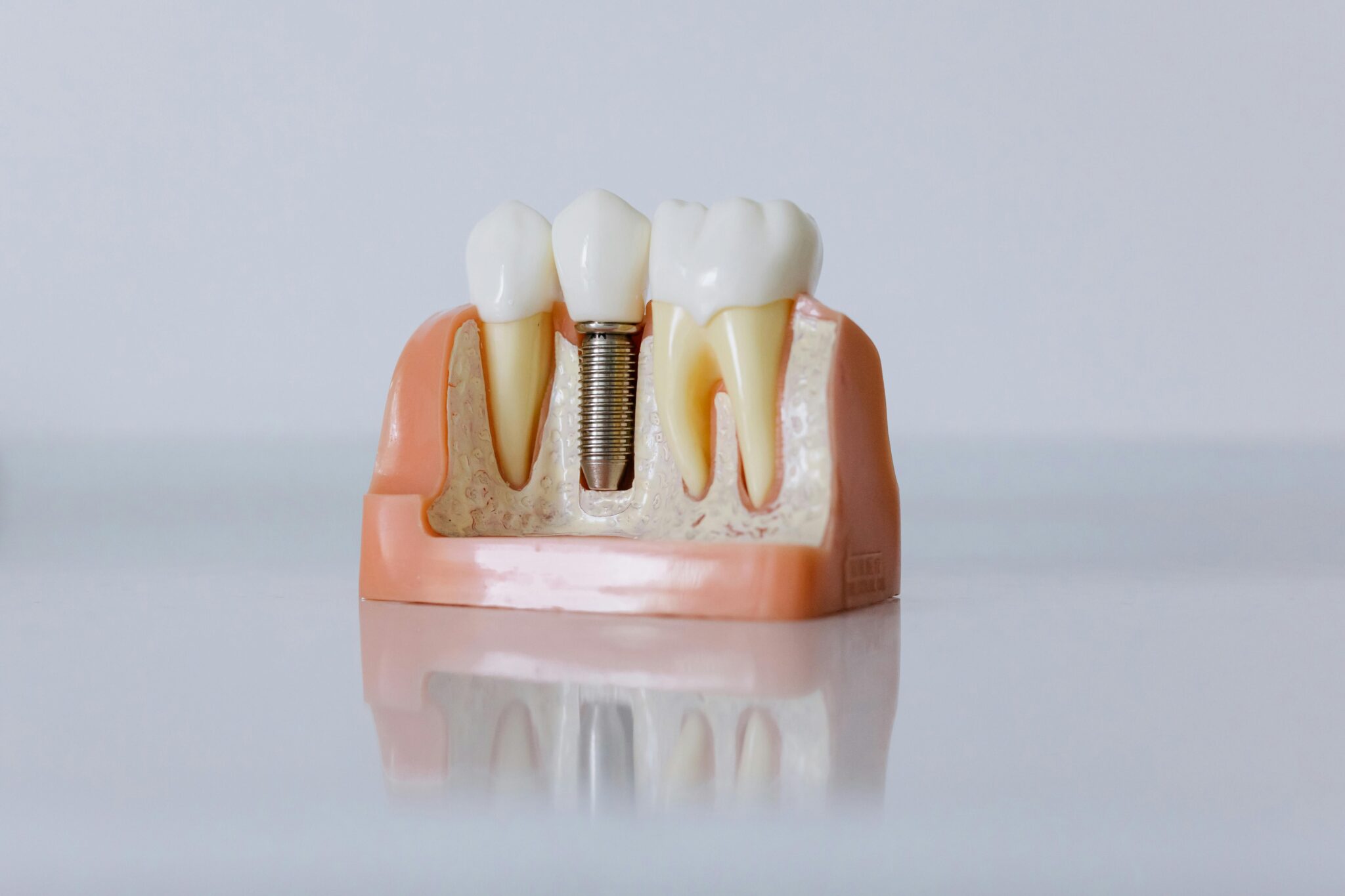 Detailed dental implant model showcasing teeth structure for educational purposes.
